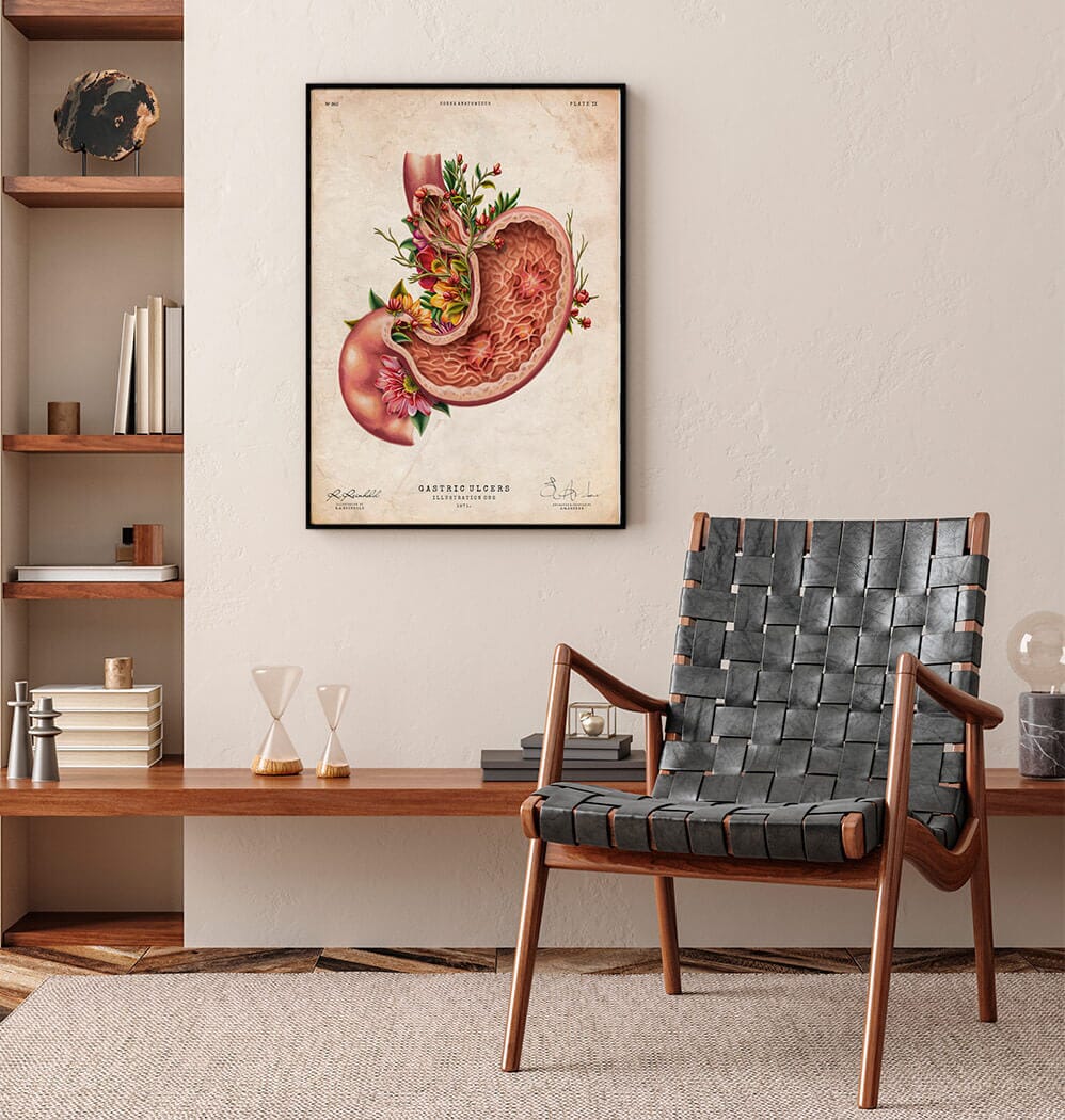 Gastric ulcers anatomy art print by Codex Anatomicus
