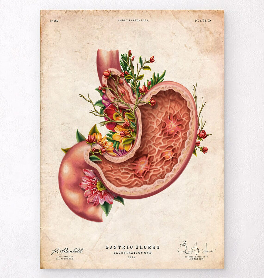 Gastric ulcers anatomy art print by Codex Anatomicus
